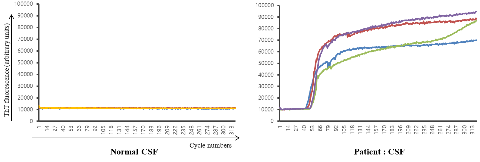 환자의 뇌척수액에서 1병원성 프리온 단백질(PrPSc)의 RT-QuIC 검사 결과